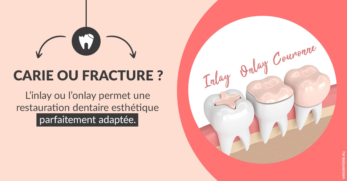 https://selarl-cabinet-docteur-monthean.chirurgiens-dentistes.fr/T2 2023 - Carie ou fracture 2