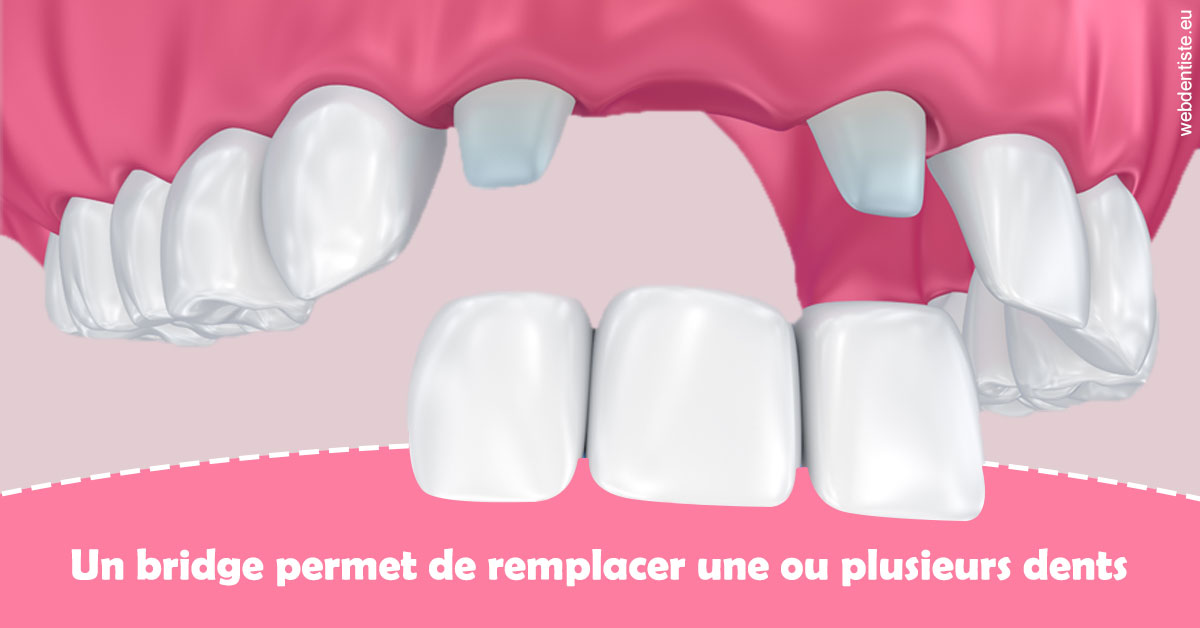 https://selarl-cabinet-docteur-monthean.chirurgiens-dentistes.fr/Bridge remplacer dents 2