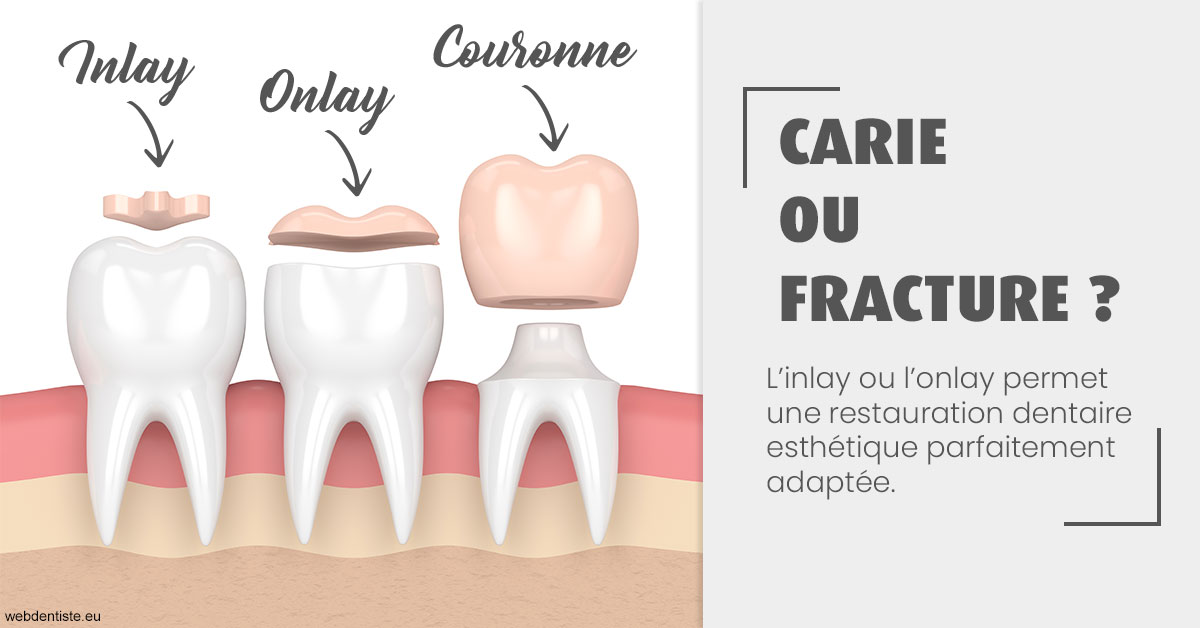 https://selarl-cabinet-docteur-monthean.chirurgiens-dentistes.fr/T2 2023 - Carie ou fracture 1