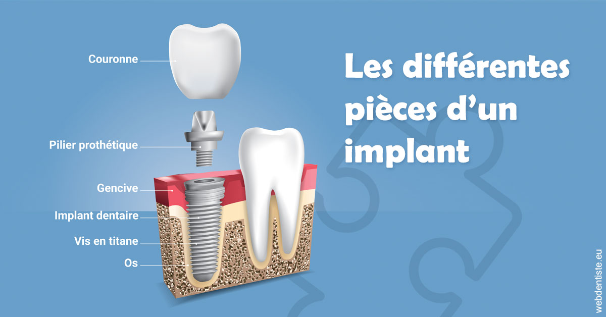 https://selarl-cabinet-docteur-monthean.chirurgiens-dentistes.fr/Les différentes pièces d’un implant 1